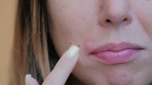 Woman touching a blemish on her face.