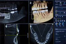 x-rays of teeth at a dentist office 