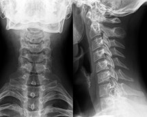 Xray of neck and cervical spine, front and side view.