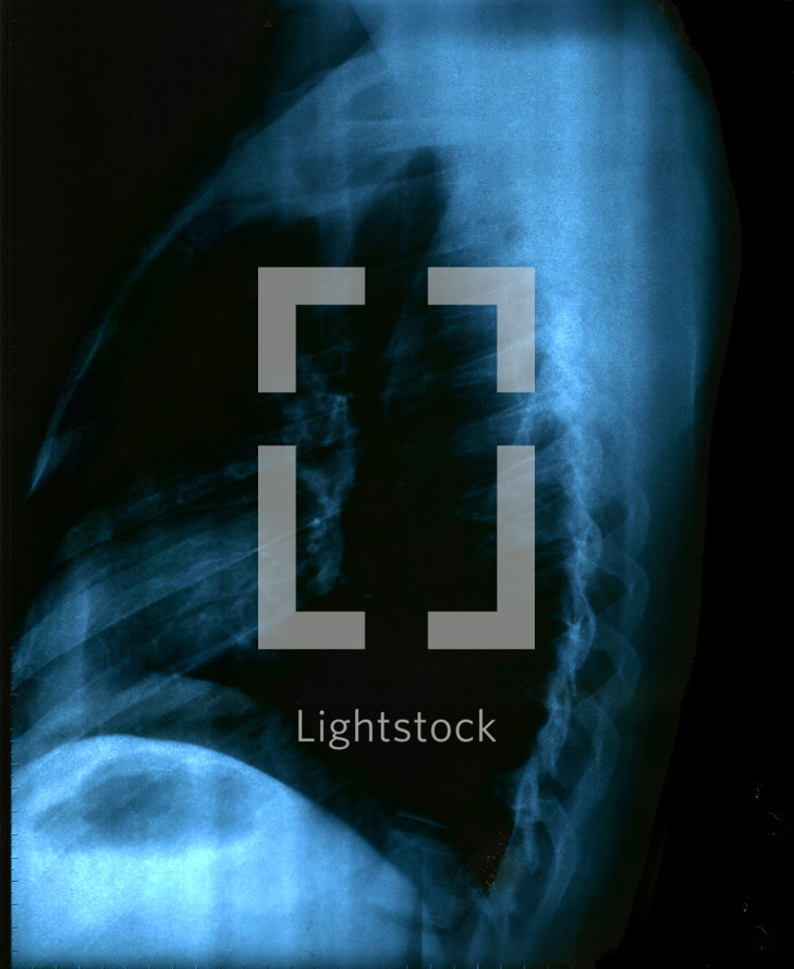 X Ray Image Of Human Healthy Chest