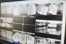 teeth x-rays 