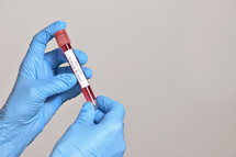 Coronavirus 2019-Ncov With Positive Blood Test