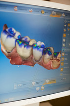 digital scan of teeth on a computer 