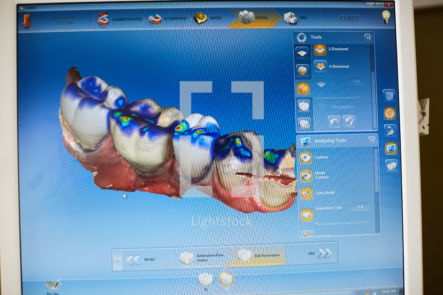digital scans of teeth on a computer at a dentist office