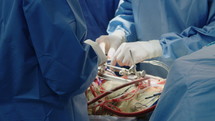 Surgeons working during open heart surgery, close up on hands and instruments.