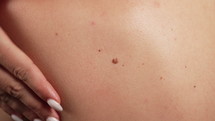 Woman's with mole on her back