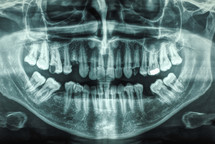 orthopantomogram single panoramic image radiograph of the mandible, maxilla and teeth
