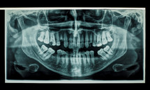 orthopantomogram single panoramic image radiograph of the mandible, maxilla and teeth