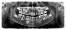 Panoramic dental x-ray of child of seven (7) years. Black and white image roentgen teeth upper and lower jaw skull of girl. Negative shot of the digital picture. Panoramic radiograph is a scanning dental X-ray of the upper jaw maxilla and lower jawbone mandible. The photo shows a child aged 7 seven years