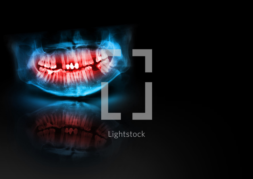 Blue and red x-ray teeth jaw skull with glow, shadow and reflection on black background. Panoramic negative image of facial man. Medical design element sample blank template horizontal paper size A4. Panoramic radiograph is a scanning dental X-ray of the upper jaw maxilla and lower jawbone mandible. Black background with with glow, shadow and reflection. Medical horizontal design template for text