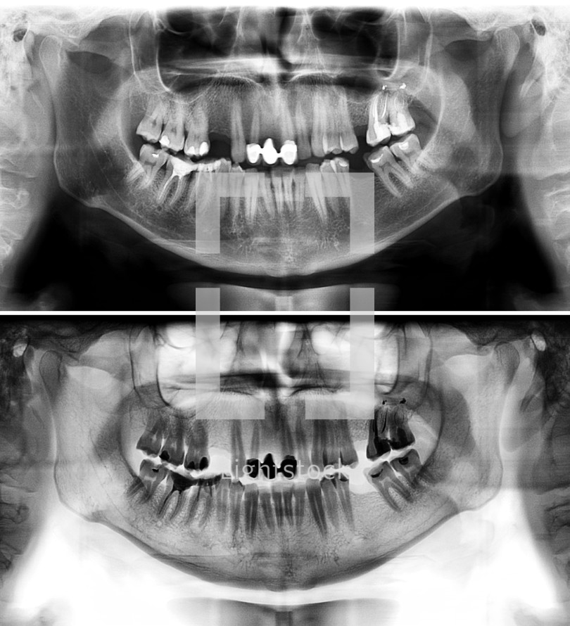 Panoramic dental x-ray of young man of thirty seven years. Black and white image roentgen teeth upper and lower jaws of skull. Two versions positive and negative shots of the digital image. Panoramic radiograph is a scanning dental X-ray of the upper jaw maxilla and lower jawbone mandible. The photo shows a young man aged thirty seven 37 years