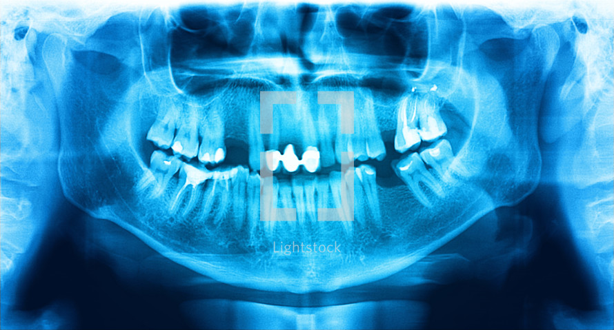 Blue x-ray teeth scan mandible. Panoramic negative image facial of young adult male. Photo was taken on digital system equipment for dental diagnostic examination upon clinical checkup. Panoramic radiograph is a scanning dental X-ray of the upper jaw maxilla and lower jawbone mandible. The photo shows a young man aged thirty seven 37 years