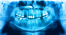 Blue x-ray teeth scan mandible. Panoramic negative image facial of young adult male. Photo was taken on digital system equipment for dental diagnostic examination upon clinical checkup. Panoramic radiograph is a scanning dental X-ray of the upper jaw maxilla and lower jawbone mandible. The photo shows a young man aged thirty seven 37 years