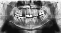 Original black white x-ray teeth scan mandible. Panoramic negative image facial of young adult male. Photo was taken on digital system equipment for dental diagnostic examination upon clinical checkup. Panoramic radiograph is a scanning dental X-ray of the upper jaw maxilla and lower jawbone mandible. The photo shows a young man aged thirty seven 37 years