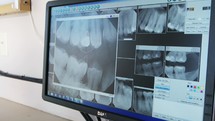 x-rays of teeth on a computer screen 