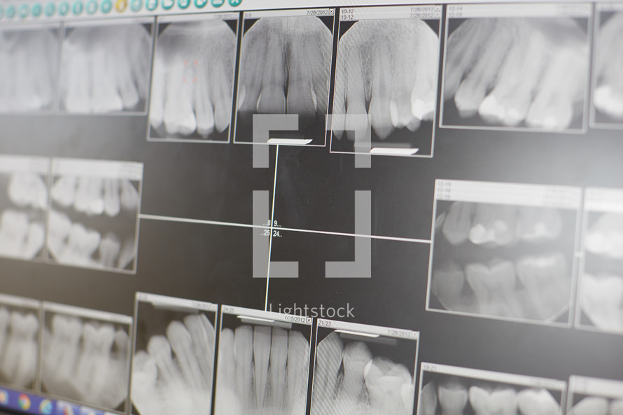 x-rays of teeth at a dentist office 