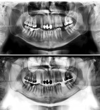 Panoramic dental x-ray of young man of thirty seven years. Black and white image roentgen teeth upper and lower jaws of skull. Two versions positive and negative shots of the digital image. Panoramic radiograph is a scanning dental X-ray of the upper jaw maxilla and lower jawbone mandible. The photo shows a young man aged thirty seven 37 years