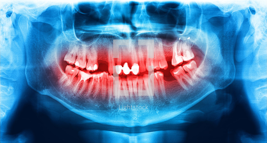 Blue and red x-ray teeth scan mandible. Panoramic negative image facial of young adult male. Photo was taken on digital system equipment for dental diagnostic examination upon clinical checkup. Panoramic radiograph is a scanning dental X-ray of the upper jaw maxilla and lower jawbone mandible. The photo shows a young man aged thirty seven 37 years