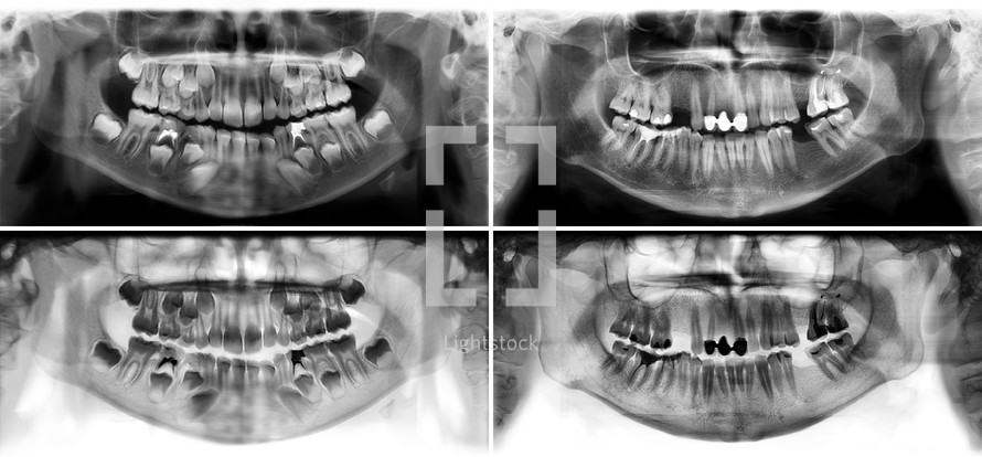 Panoramic dental x-ray tooth's of young man of 30 (thirty) and child of 7 (seven) years. Black and white image roentgen teeth upper and lower jaws of skull. Two versions positive and negative picture. Panoramic radiograph is a scanning dental X-ray of the upper jaw maxilla and lower jawbone mandible. 
