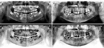 Panoramic dental x-ray tooth's of young man of 30 (thirty) and child of 7 (seven) years. Black and white image roentgen teeth upper and lower jaws of skull. Two versions positive and negative picture. Panoramic radiograph is a scanning dental X-ray of the upper jaw maxilla and lower jawbone mandible. 
